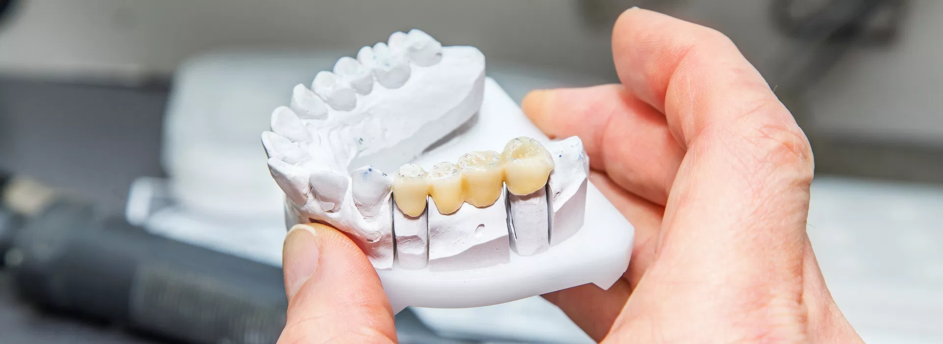 dental bridge Jupiter FL replace missing tooth
