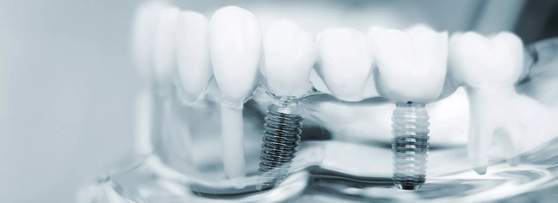  digital implant placement Jupiter FL