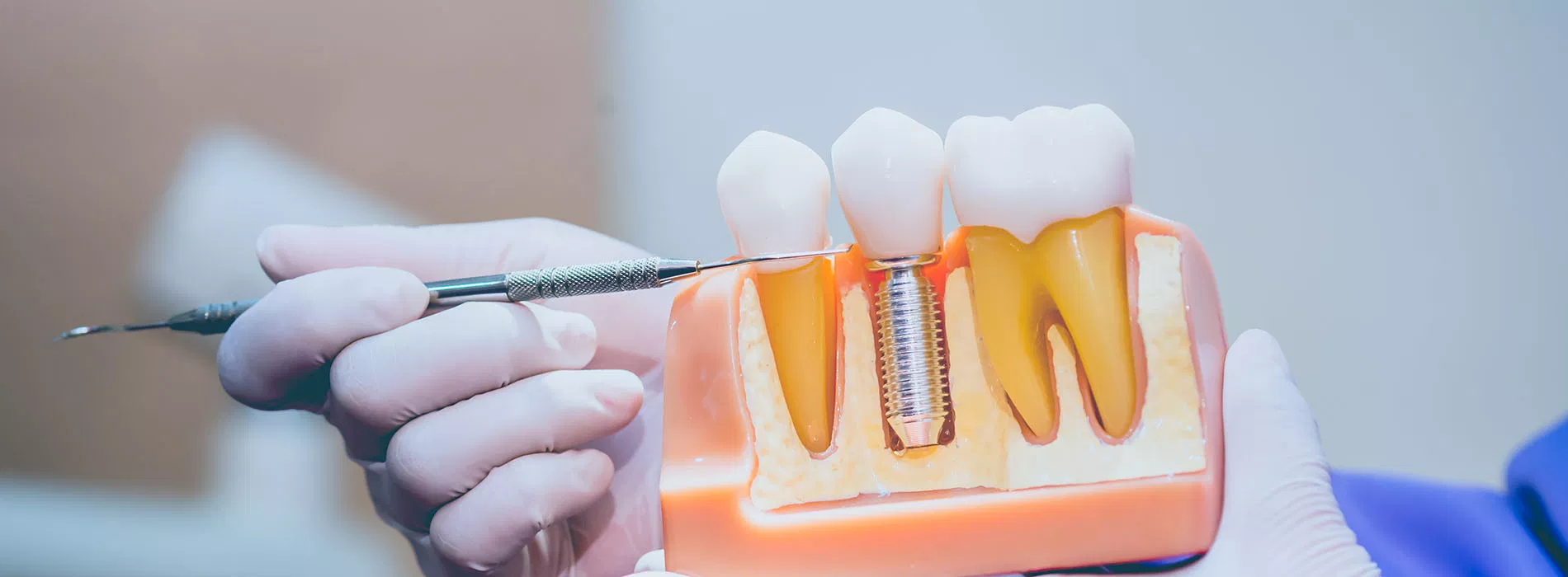 implant supported denture Jupiter FL