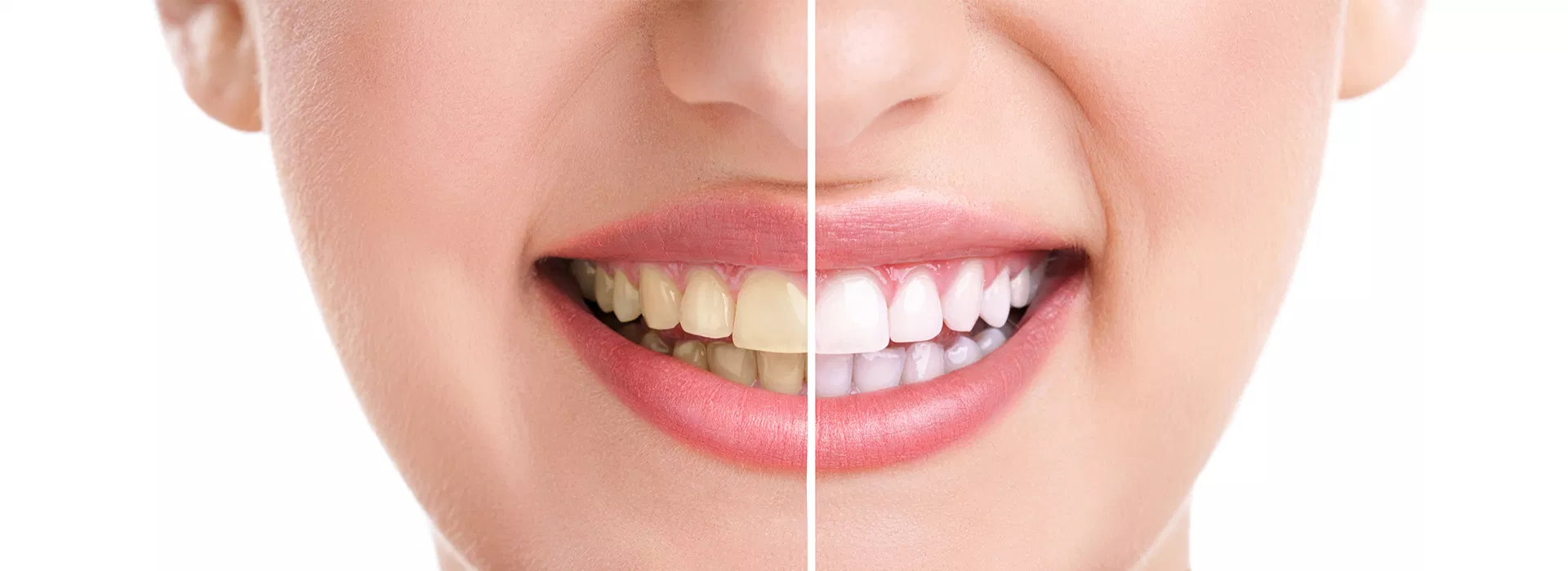 zoom whitening dentist Jupiter FL